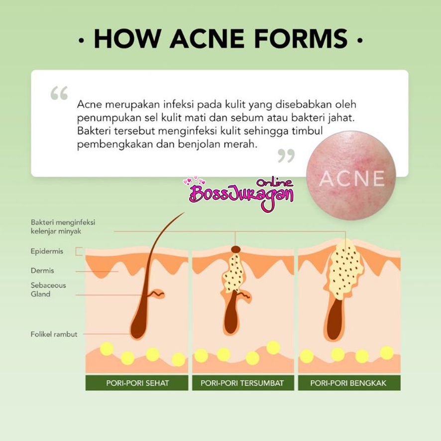 (BOSS) YOU AcnePlus Triple Action Spot Care 15gr Gel Jerawat - Acne Spot Gel