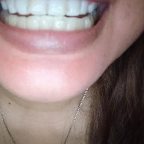 SNAP ON SMILE SEPASANG (GIGI ATAS dan GIGI BAWAH)