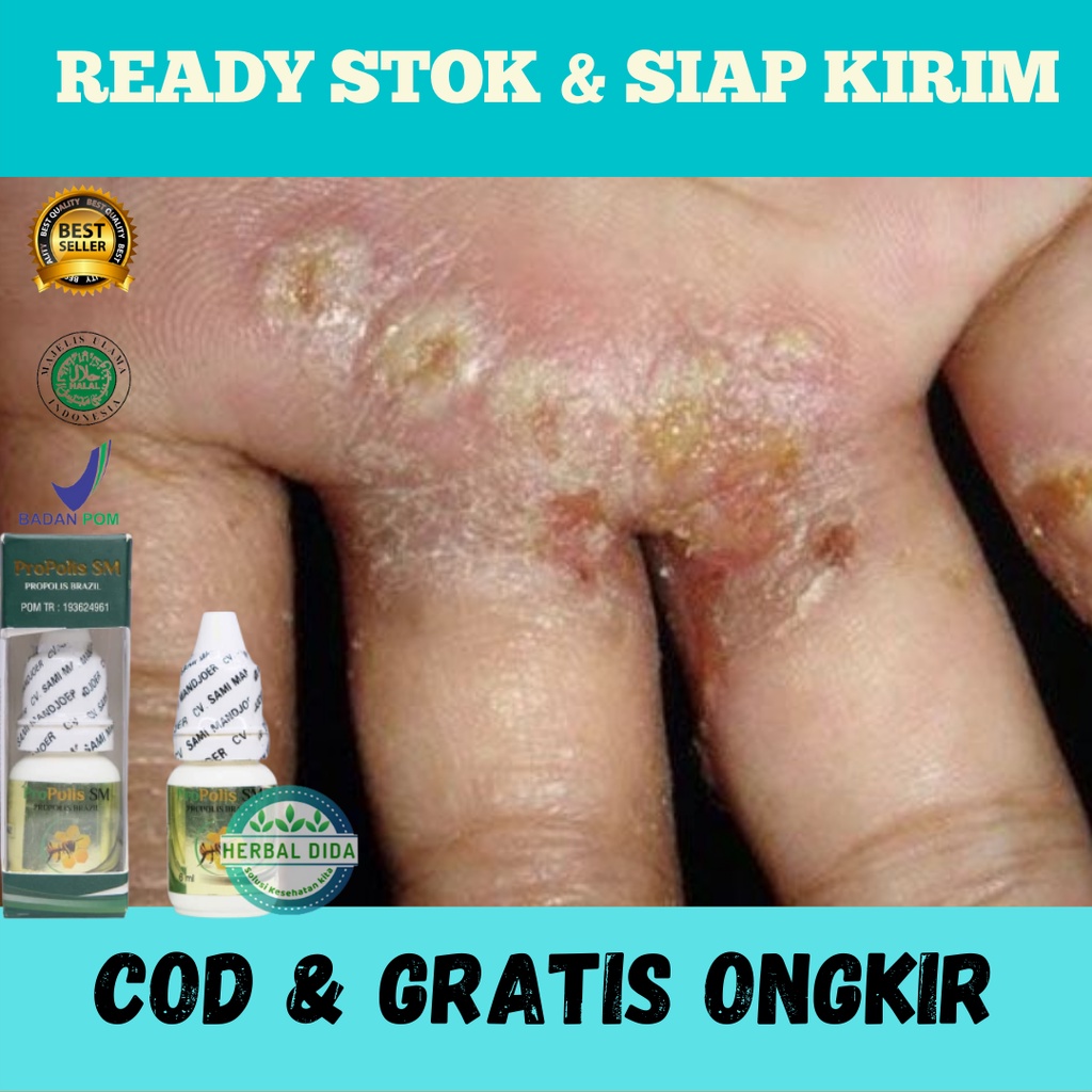 Obat Borok Budug Bernanah, Obat Kulit Gatal, Obat Herbal Jamur Kulit, Obat Herbal Luka Borok, Obat H