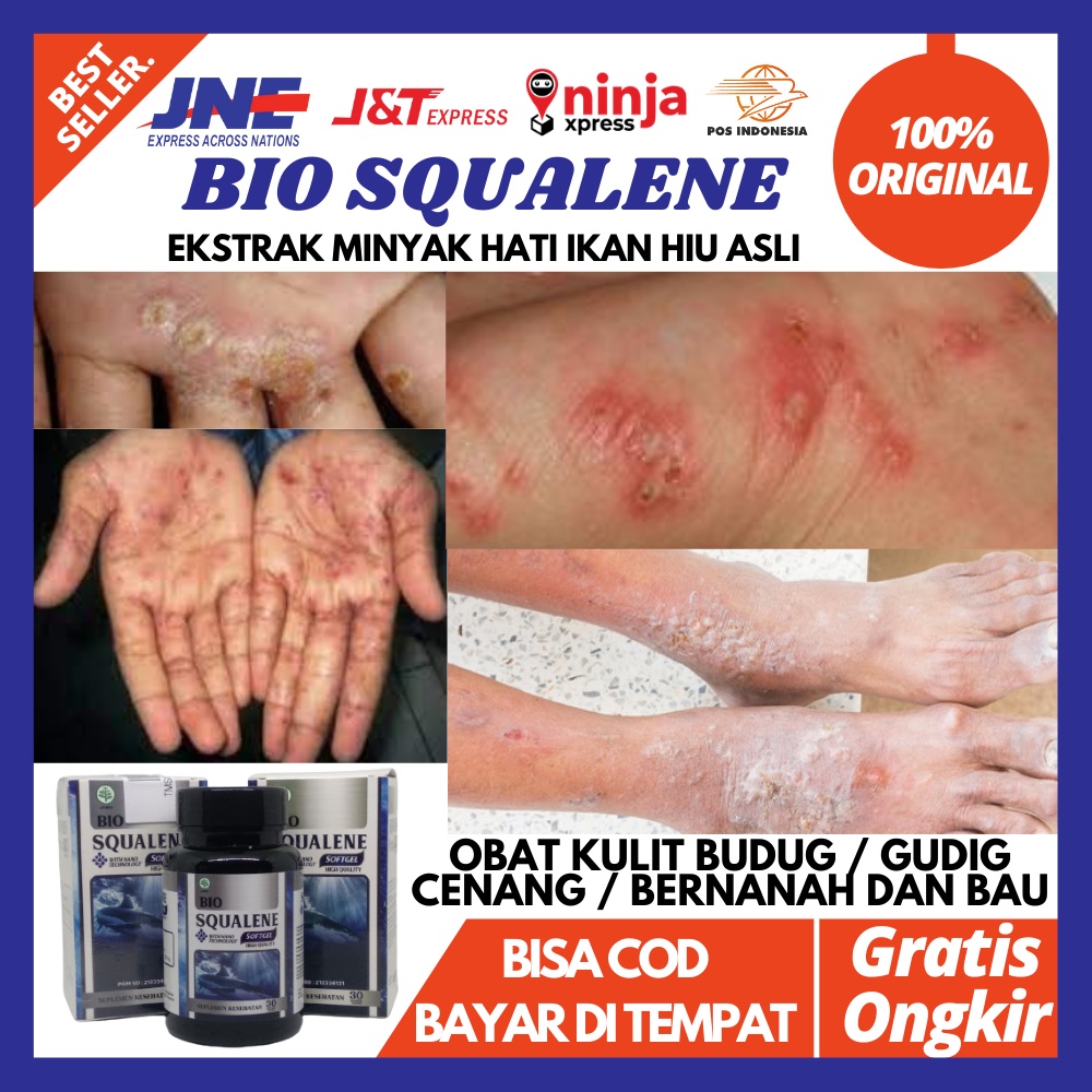 Obat Budug dan Gatal / Obat Kulit Budugan / Obat Budug di Telapak Tangan / Budug di Kaki / Obat Budu