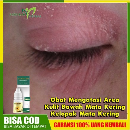 Obat Mengatasi Area Kulit Bawah Mata Kering, Kelopak Mata Kering, Bengkak, Berwarna Merah, dan Gatal