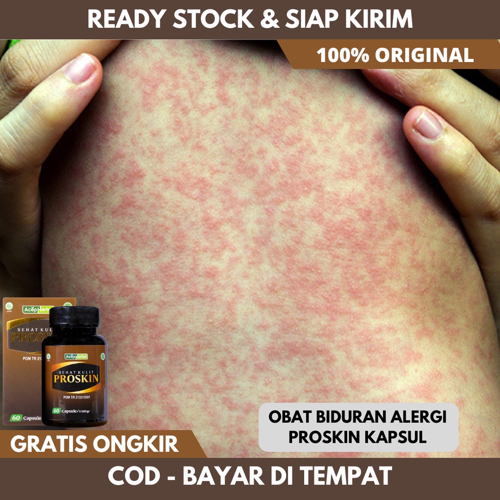 Obat Biduran Alergi, Biduran Menahun, Biduran Anak, Kaligata, Alergi Gatal, Alergi Dingin, Alergi Se