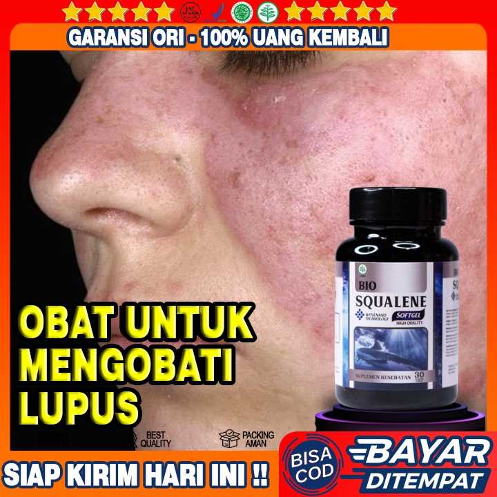 Obat Mencegah Penyakit Lupus - Lupus Eritematosus - Obat Herbal Penyakit Lupus - Obat Kulit Terkena 