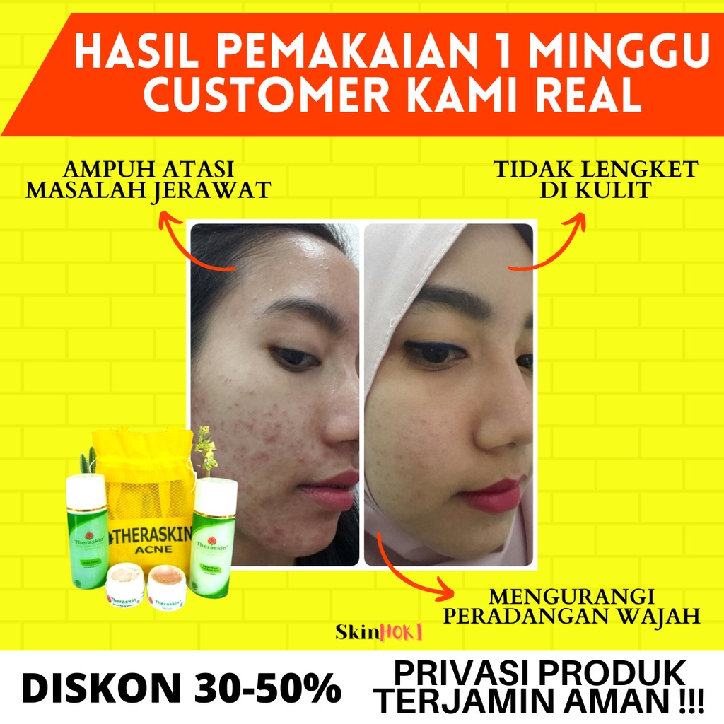 THERASKIN PAKET ACNE PENGHILANG JERAWAT PENCERAH WAJAH PAKET THERASKIN  ACNE PERAWATAN WAJAH BERJERAWAT ORIGINAL BPOM