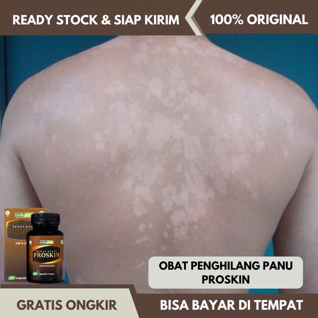 Obat Panu Seluruh Badan, Obat Panu di Punggung, Obat Panu di Wajah, Obat Bercak Putih di Kulit, Obat