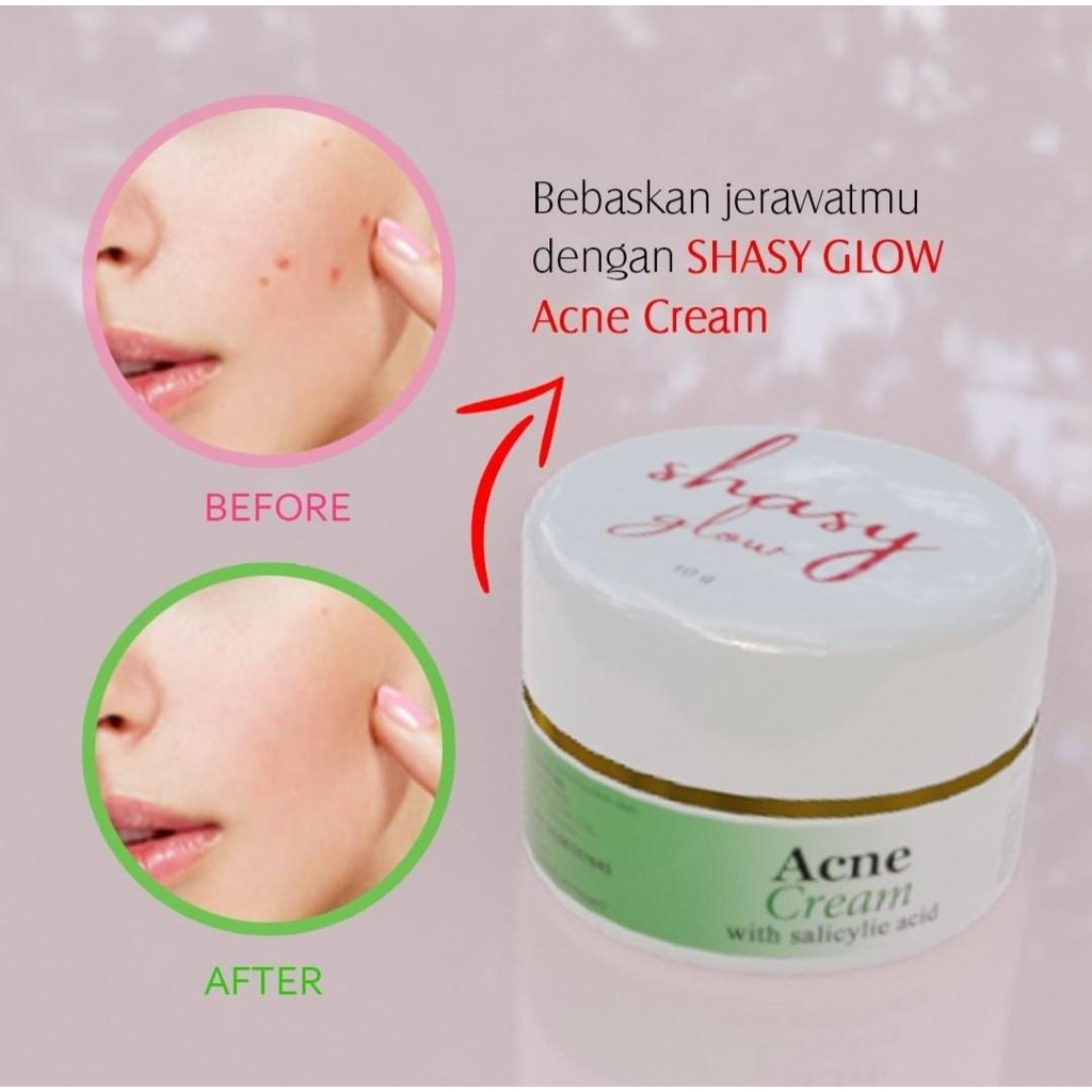 SHASY GLOW ACNE CREAM WITH SALICYLIC ACID  REG BPOM