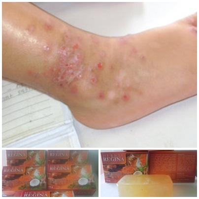 Sabun Herbal Regina Penghilang Panu, Kurap, Kudis, Kadas, Cacar,, Bau Badan Dan Lainnya (Bisa COD)