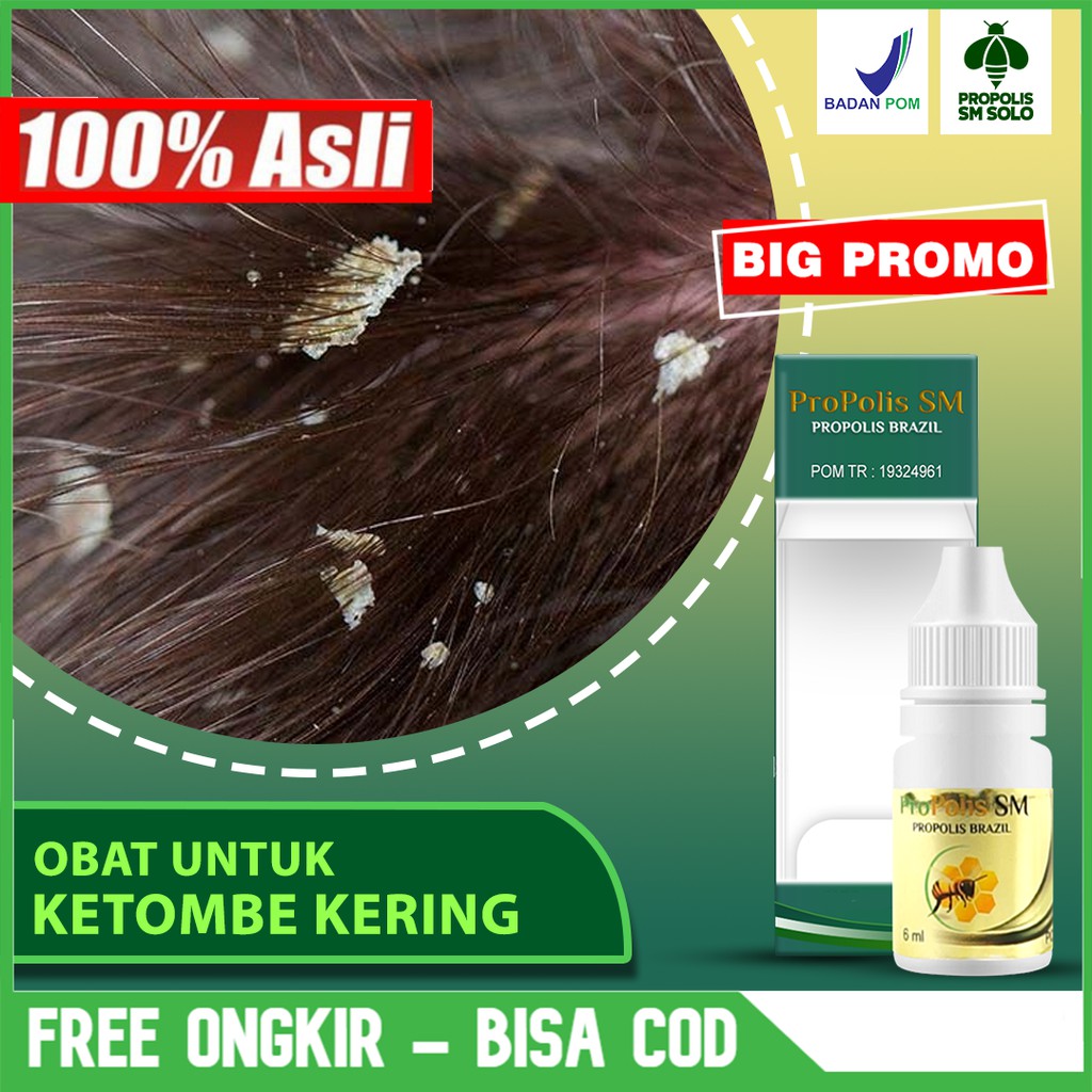 

Obat Ketombe Kering, Basah, Parah, Gatal Kulit Di Kepala - Herbal PROPOLIS SM Brazil ASLI Di Solo