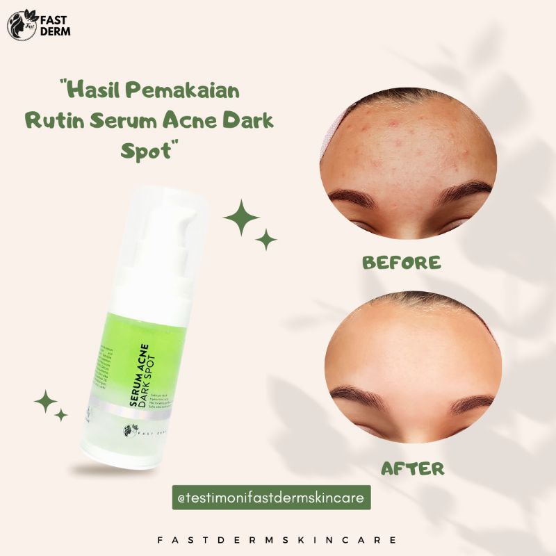 SERUM ACNE DARK SPOT FAST DERM SERUM JERAWAT DAN BEKAS JERAWAT KEMERAHAN