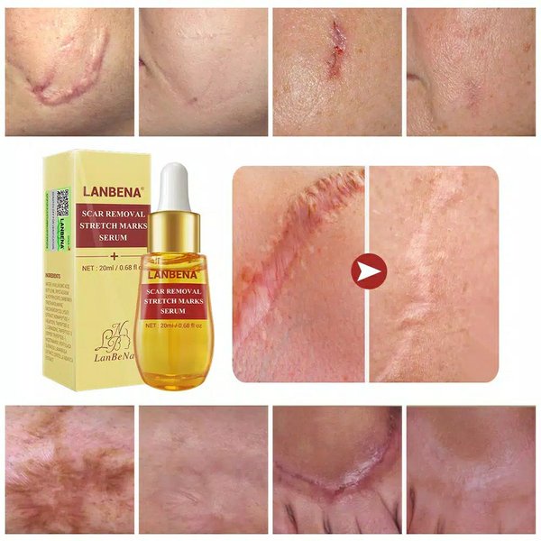 LANBENA SCAR REMOVAL STRETCH MARKS SERUM Penghilang Bekas Luka Stretch Mark