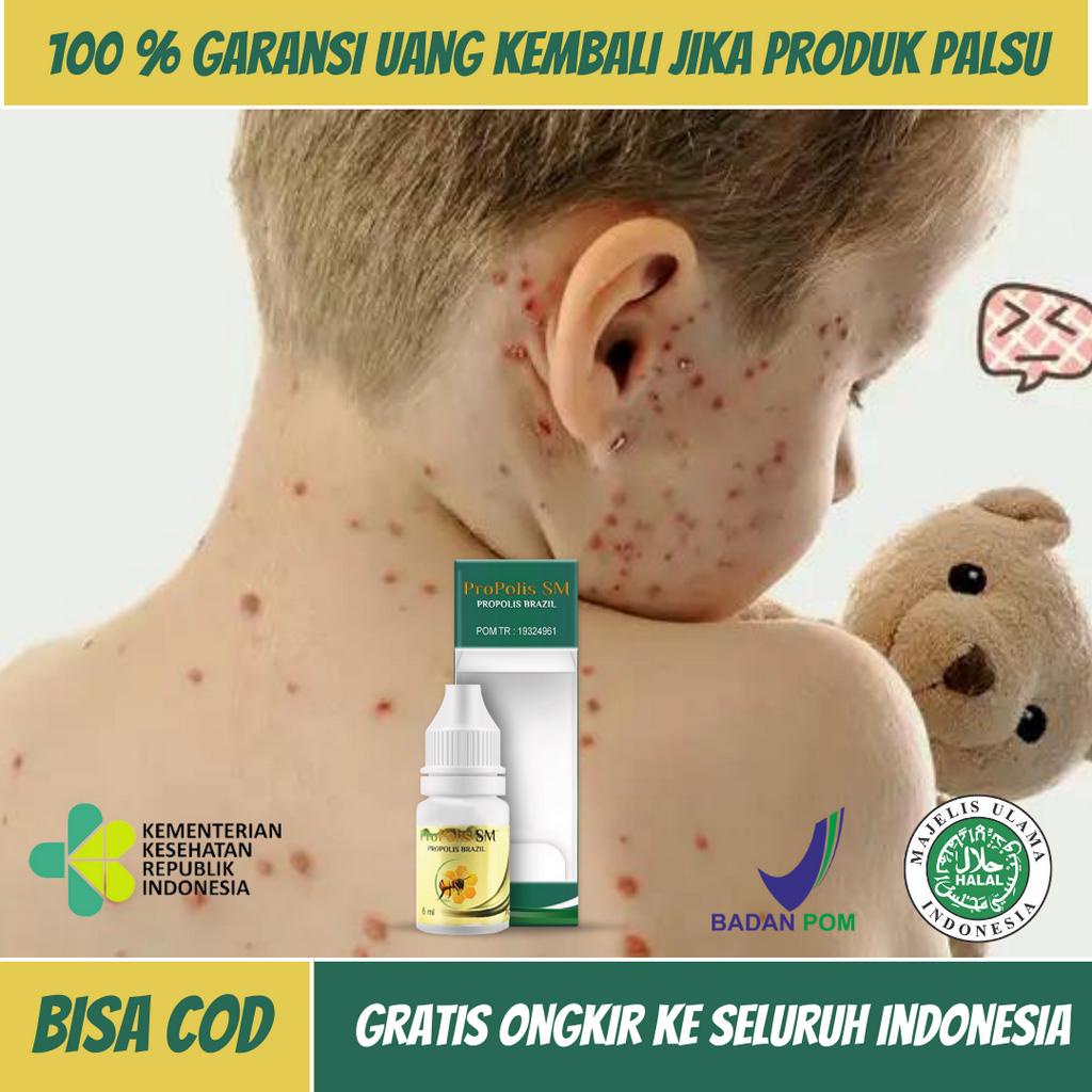 Obat Cacar Air, Obat Cacar Api, Obat Oles Cacar, Obat Penghilang Bekas Cacar, Obat Campak Anak, Obat