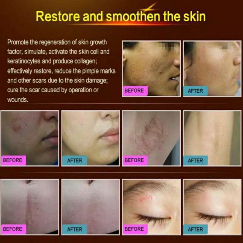 LANBENA Original Acne Removal Cream Perbaikan Kulit