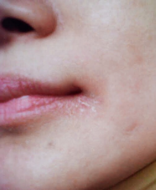 Cream Iritasi Aknèlab 5g (krim anti iritasi kulit wajah)