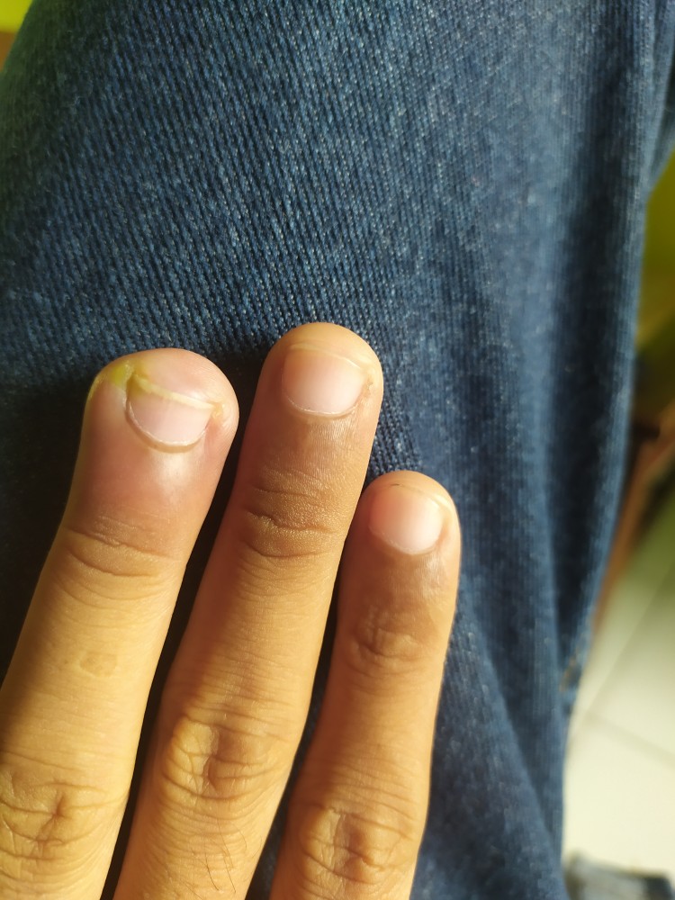 Aluminium Foil Seal Botol Pet Diameter 20 Mm 2 Cm