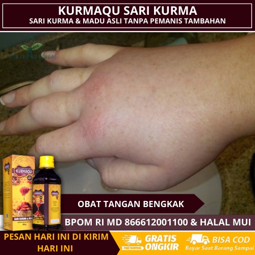 Obat Tangan Bengkak, Jari Tangan Bengkak, Jari Jari Tangan Kaku, Mengatasi Tangan Bengkak Dgn Kurmaq