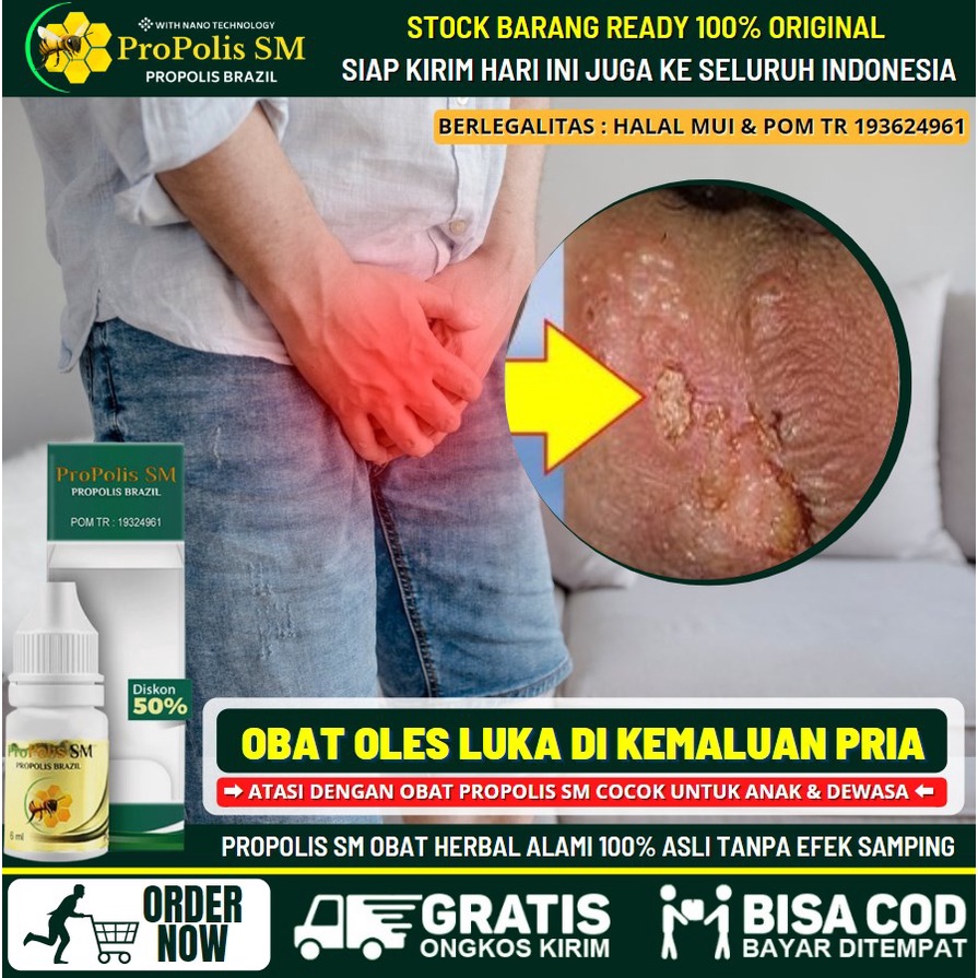 Salep Penis Lecet, Penis Gatal, Penis Bruntusan, Benjolan di Penis, Obat Oles Tanpa Perih Untuk Peni