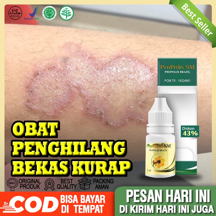 Obat Kurap, Penghilang Kurap, Pembersih Kurap, Kurap Gatal, Pembersih Bekas Kurap, Kurap Sakit