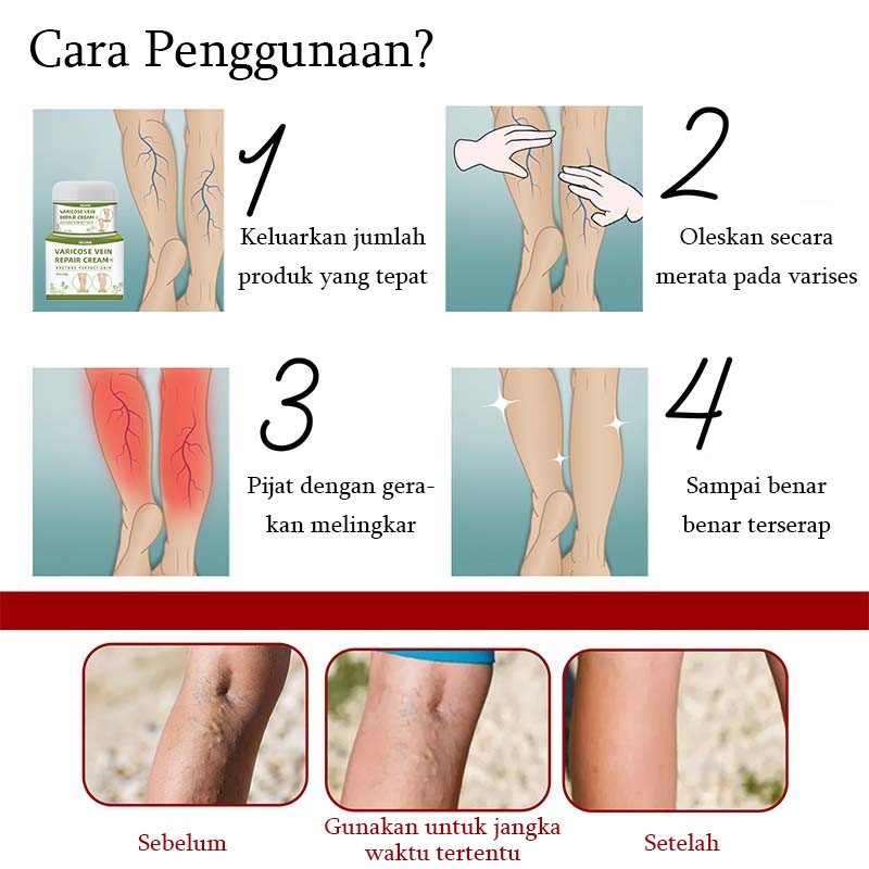 Terlaris !!! Varicose Veins Obat Varises Varikokel Bengkak Benjolan Buah Zakar Nyeri Testis Paling Ampuh Varicose Veins Treatment Cream/Obat Krim Varises Parises Tanpa Operasi