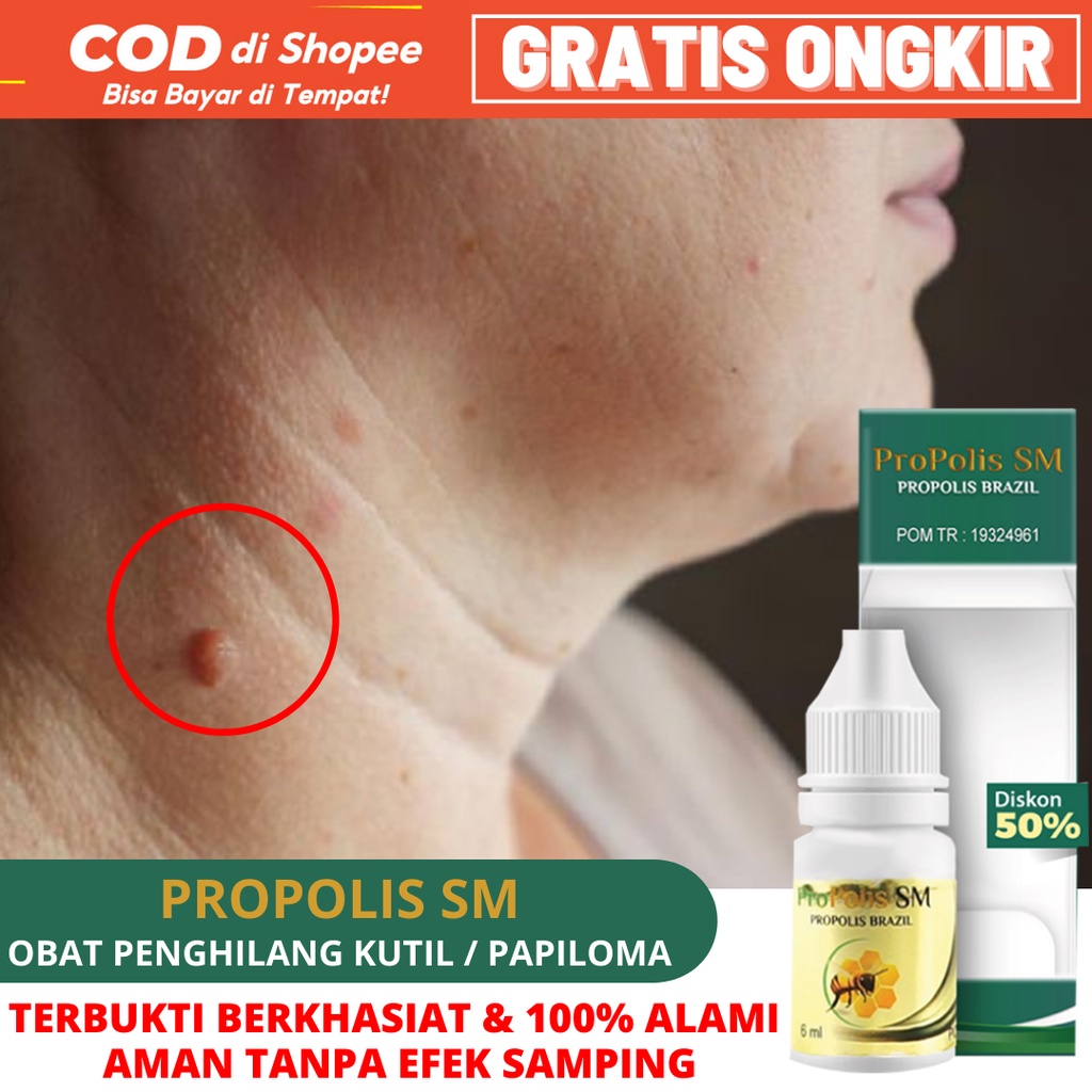 Obat Papiloma, Obat Penghilang Papiloma di leher, Obat Papiloma Leher, Obat Penghilang Lutil Di Lehe