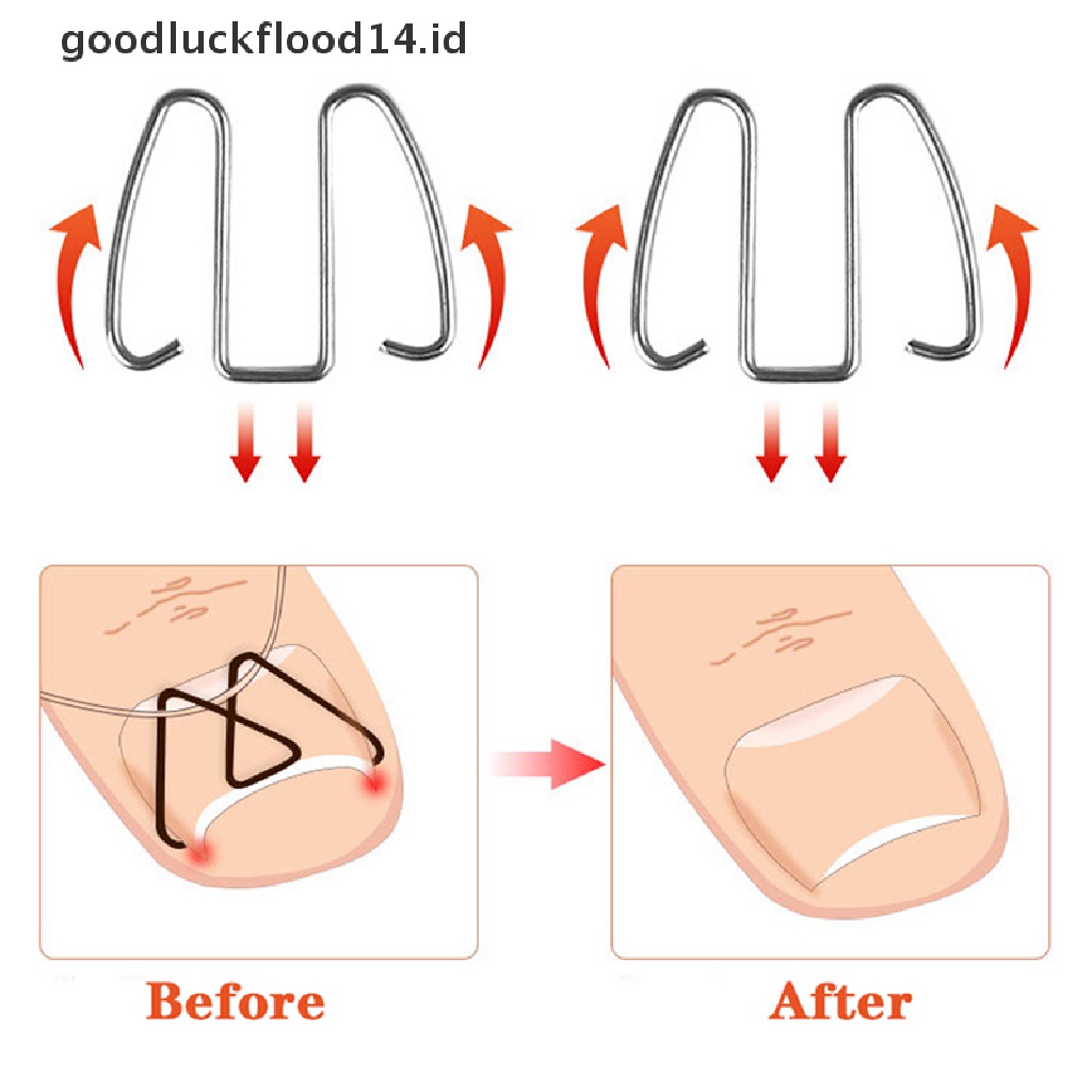 [OOID] Nail Art Ingrown Toe Nail Correction Tool Toenail Nail Orthosis Paronychia Clip ID