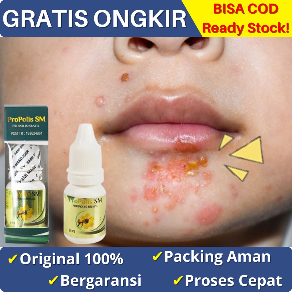 Obat Impetigo Untuk Anak dan Bayi, Infeksi Kulit, Luka Merah, Gatal Gatal, Ruam Pada Kulit, Biduran,