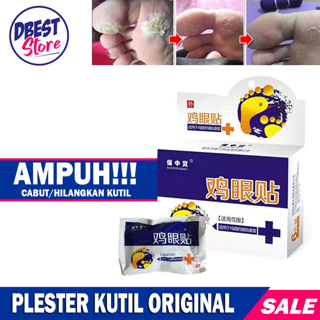 (1Box isi 6 Pcs) Plester Obat Kutil &amp; Mata Ikan / Kapalan Koyo Kutil / Plester Obat Penghilang Kutil