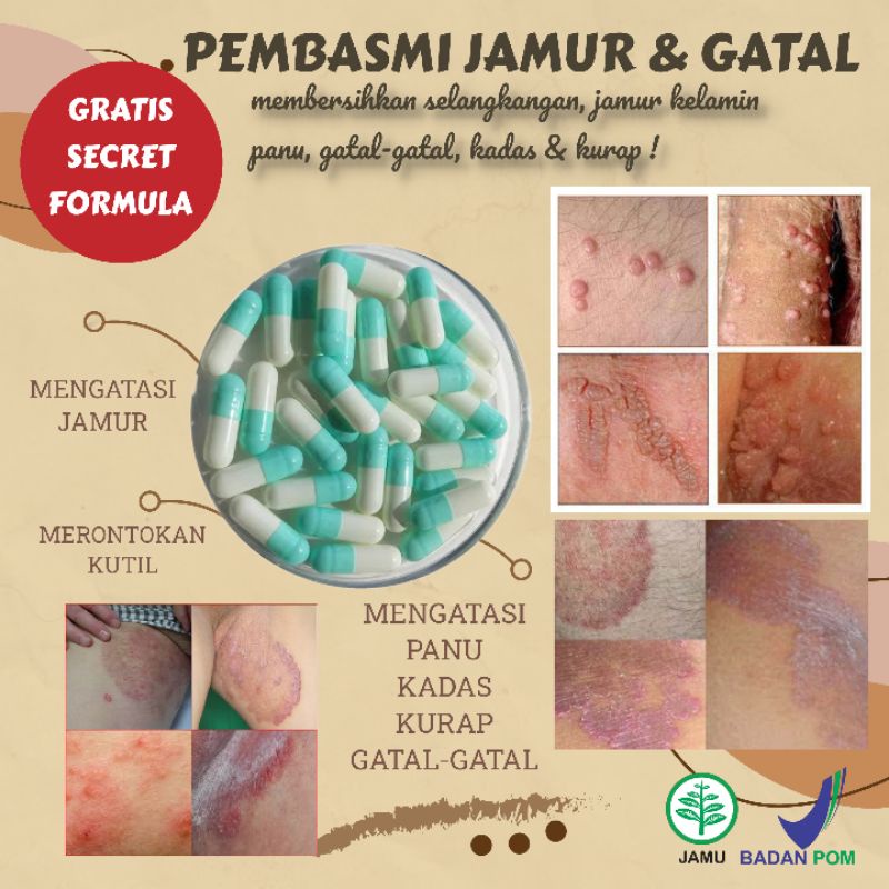 Obat Kutil - Obatl Kutil Kelamin - Obat Gatal Selangkangan - Obat Gatal Kulit - Obat Eksim - Obat Ga