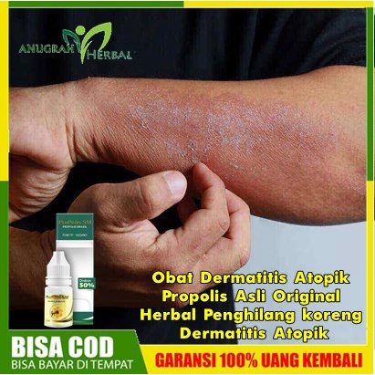 Jual Obat Dermatitis Atopik Propolis Asli Original - Herbal Penghilang ...