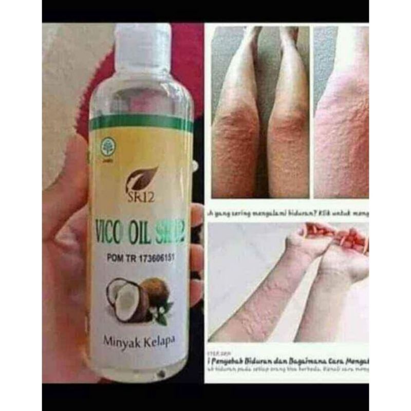 VICO SR12 AMPUH ATASI KALIGATA BIDURAN GATAL GATAL ALERGI KULIT SENSITIF/OBAT ALERGI/OBAT GATAL GATA