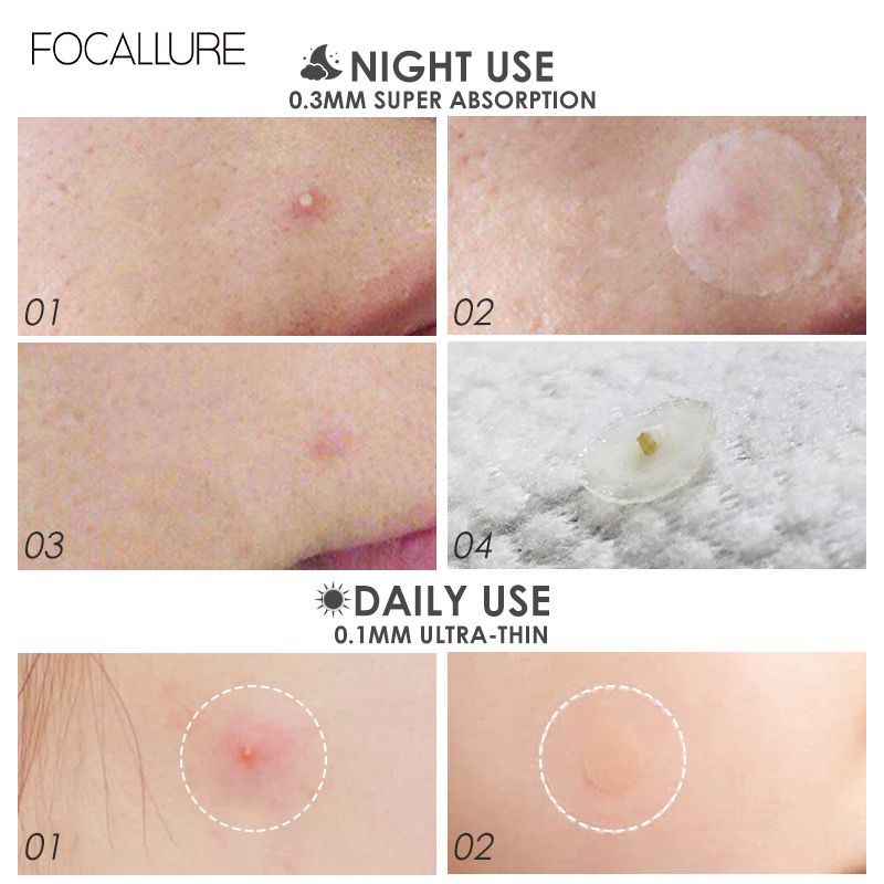 BPOM FOCALLURE Spot Patch Acne Treatment Day/Night Sticker Jerawat Acne FA186