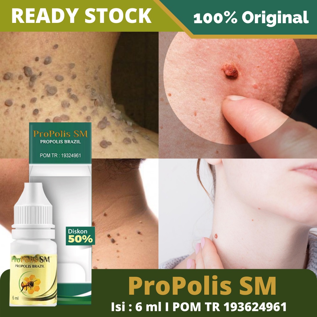 Obat Daging Jadi / Daging Tumbuh / Keloid - Papiloma - Penghilang / Perontok / Pengempis Benjolan Kutil - Kutil di Leher - Obat Kutil di Kelopak Mata - Kutil di Wajah / Tubuh - Obat Tetes Kutil Alami - Propolis SM Brazil