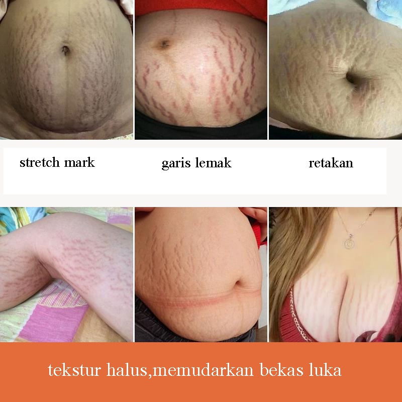 Stretch Mark Cream 45g / Penghilang Stretch Mark / Stretch Marks Pilihan Ibu / BPOM Penghilang Stretch Mark Ampuh / Mengencangkan kulit, mengembalikan kehalusan dan elastisitas