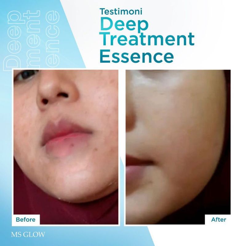 Ms Glow Deep Treatment Essence Centella Memperbaiki Skin Barrier