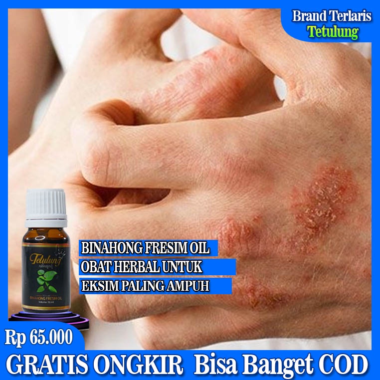 Fresim Oil, Obat Eksim, Eksim Kering, Eksim Kering Menahun, Eksim Basah, Obat Ampuh Untuk Eksim, Oba