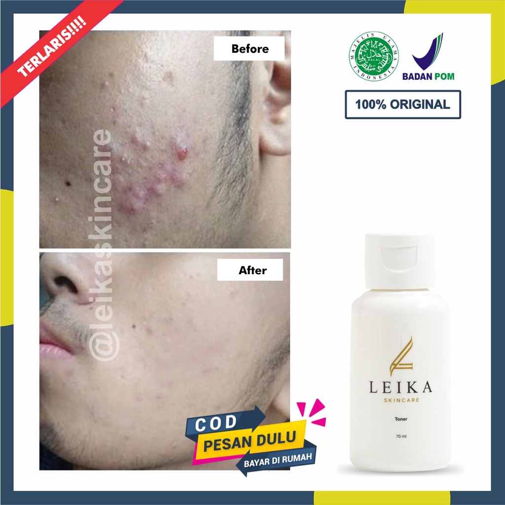 Toner Penghilang Jerawat Pria Ampuh Permanen Toner Untuk Kulit Berjerawat Original Toner Acne BPOM H