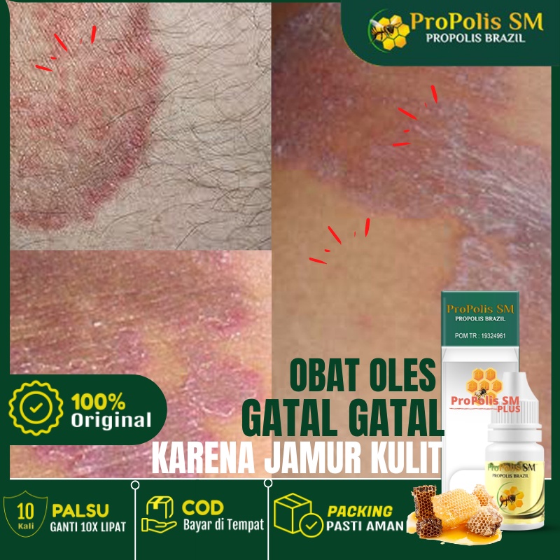 Obat Kulit Eksim - Obat Eksim Basah dan Kering - Obat Kulit Gatal2 Eksim - Obat Eksim Gatal - Obat Eksim Menahun - Propolis SM Cocok untuk Penyakit Kulit (jamur kulit,kudis.kurap,koreng,biduran,alergi) )BUKAN SALEP OBAT CINA