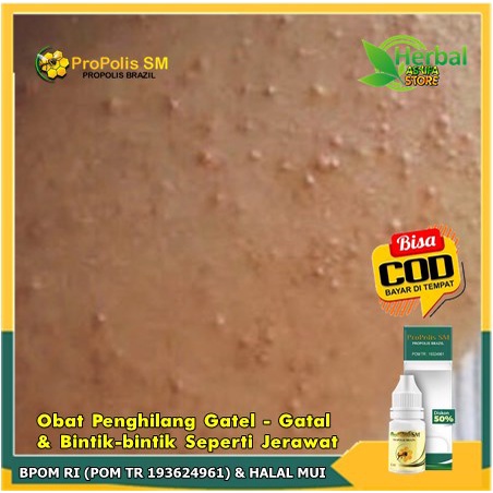 Obat Penghilang Gatel - Gatal & Bintik-bintik Seperti Jerawat, dan bekasnya menghitam | Keratosis Pi