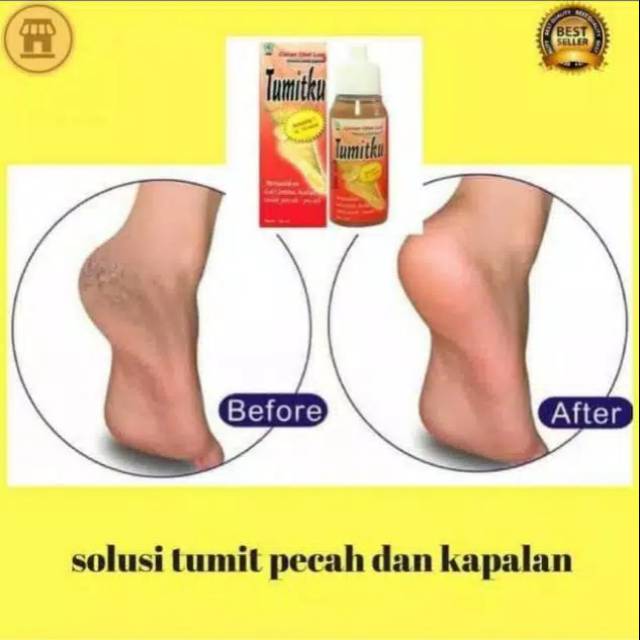 Tumitku solusi tumit pecah pecah