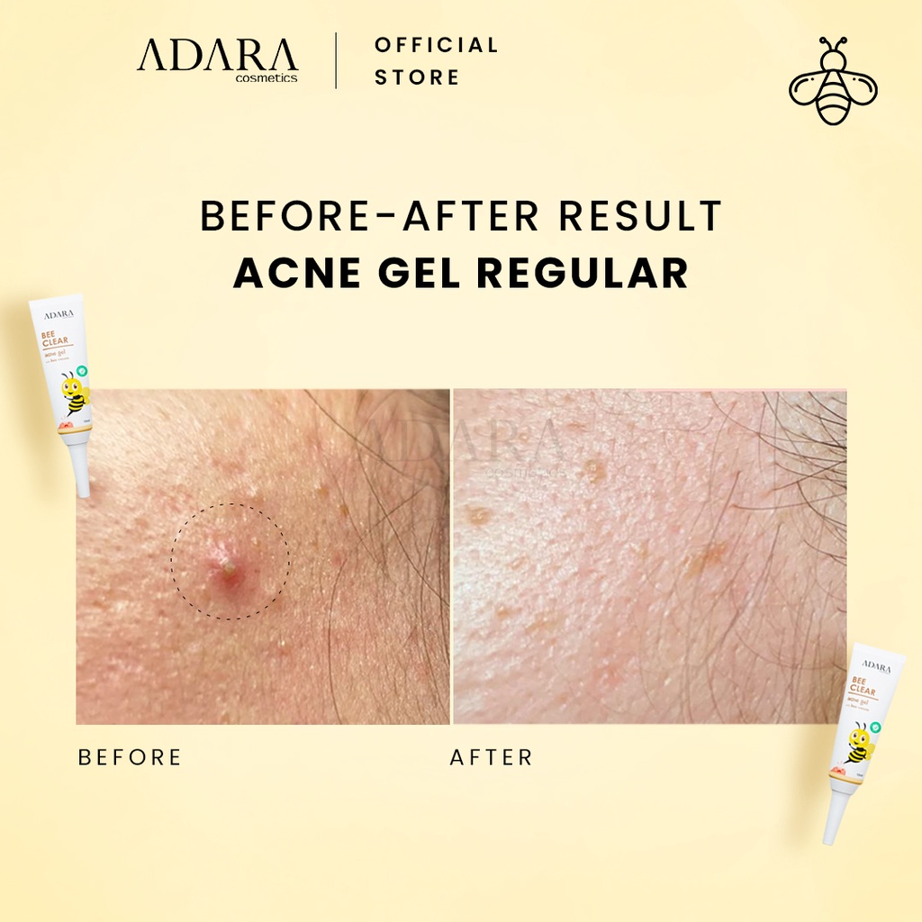 ADARA - Bee Clear Acne Gel