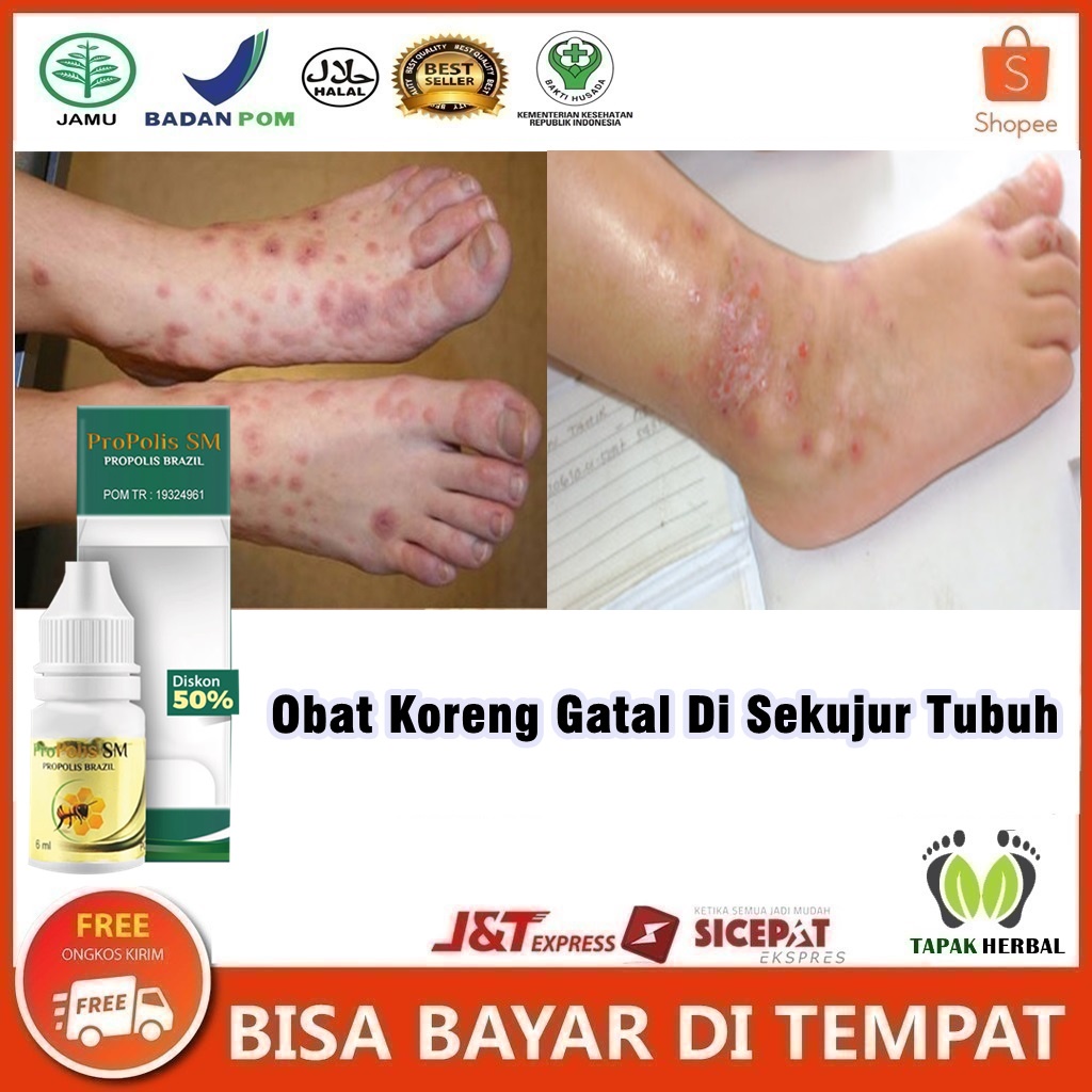 Obat Koreng Gatal Di Sekujur Tubuh - Obat Koreng, Penghilang Koreng Gatal Di Kaki, Kepala, Ketiak,