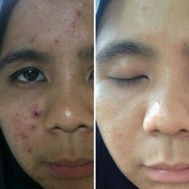 Acne Spot Inflamasi Aknèlab (obat totol jerawat) 5gr