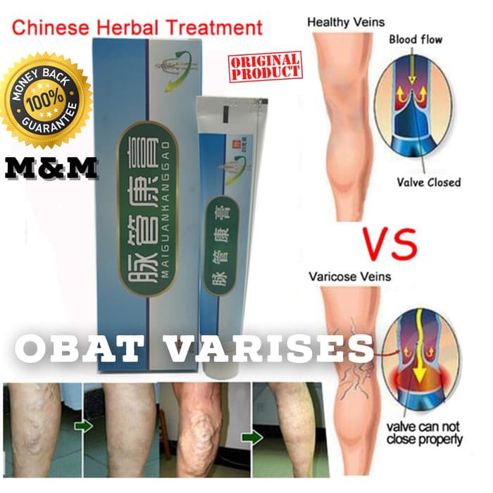 Ampuh Obat Varises Salep Penghilang varises / Parises Terbukti