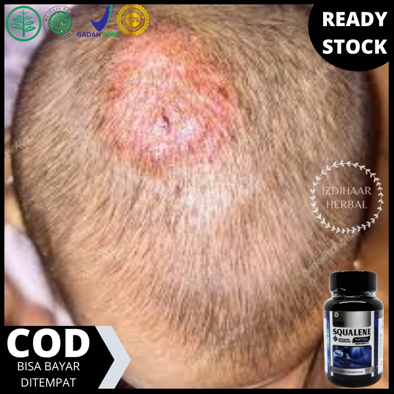 Obat Tinea Kapitis Jamur di Kepala, Obat jamur kulit kepala, Salep penghilang jamur kepala, Obat tin