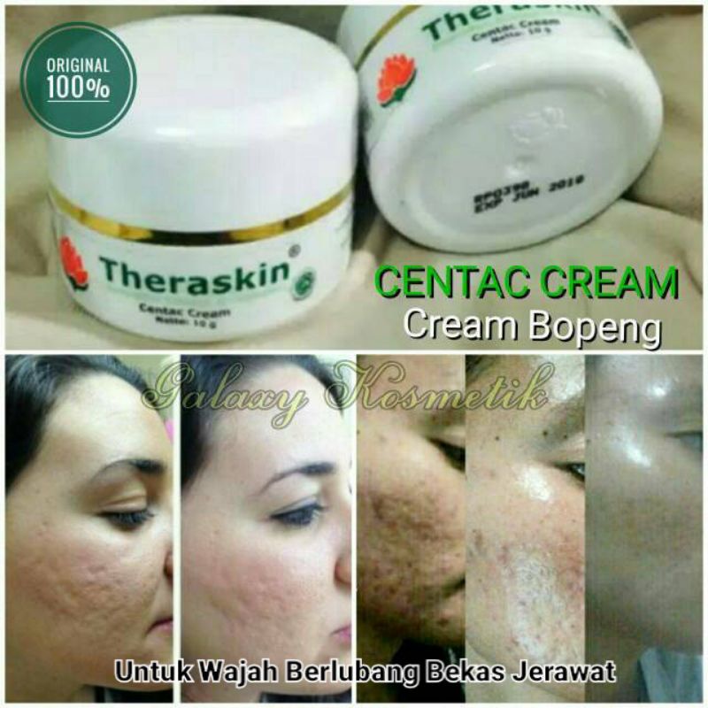 THERASKIN CENTAC CREAM - UNTUK WAJAH BELUBANG / BOPENG / SCAR - ORIGINAL 100%