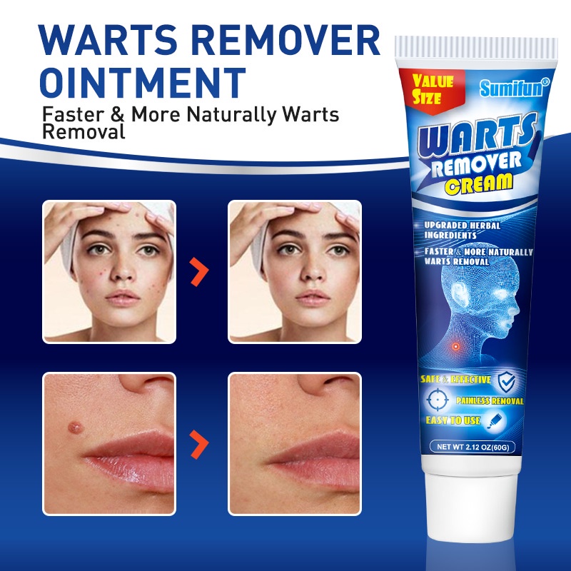 Sumifun Wart Remover Cream Skin Tag Remover Ointment 60gr - Menghilangkan Kutil Tahi Lalat Mata Ikan