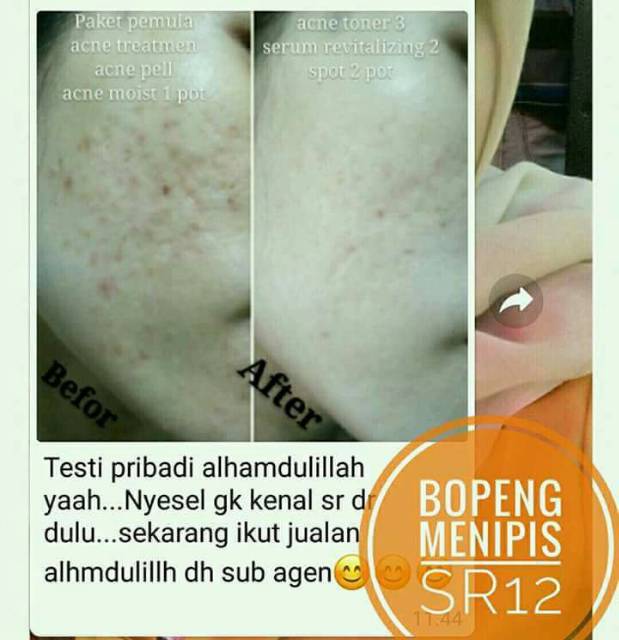 ACNE PEEL BHA30% / ATASI BOPENG / MENGANGKAT KOMEDO MENGURANGI BEKAS JERAWAT &amp; BRUNTUS