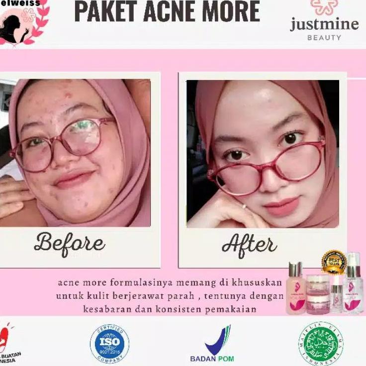 codeAa1A9--ORIGINAL 100% JUSTMINE BEAUTY BPOM Glow / Remove / Jelly Acne / Ultima / Acne More Forte 