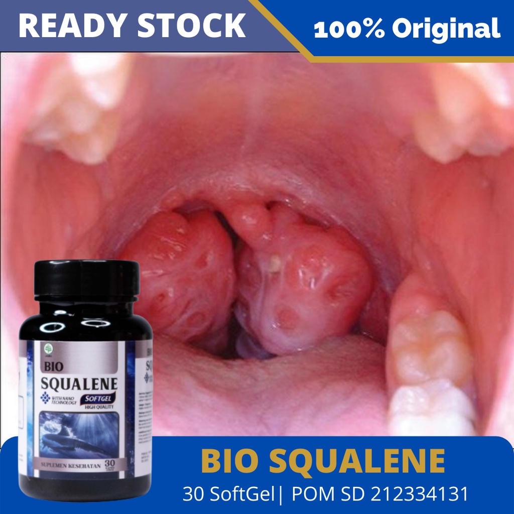 Obat Amandel Bengkak Anak Dan Dewasa, Obat Amandel Susah Menelan, Tonsil Akut Dan Kronis Herbal, Radang Amandel, Radang Tenggorokan, Amandel Bernanah, Sakit Menelan – Bio Squalene 100% Original BPOM