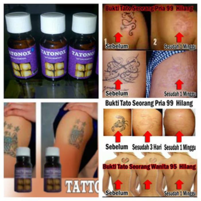 Tattonox Penghilang Tatto