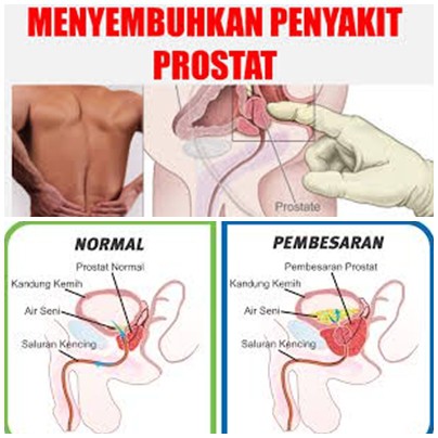 H2O2 és prostatitis A KVF prosztatitis kezelése